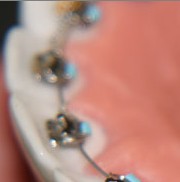 STB lingual brackets