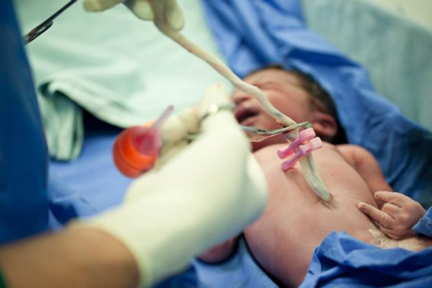 Umbilical Cord Clamp